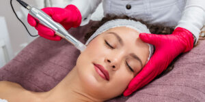 Microneedling